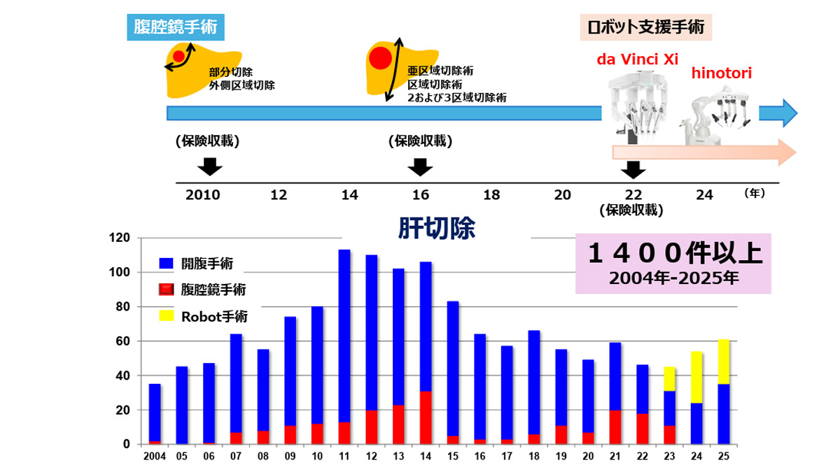 肝臓手術の進化 タイムラインと年別術式棒グラフ