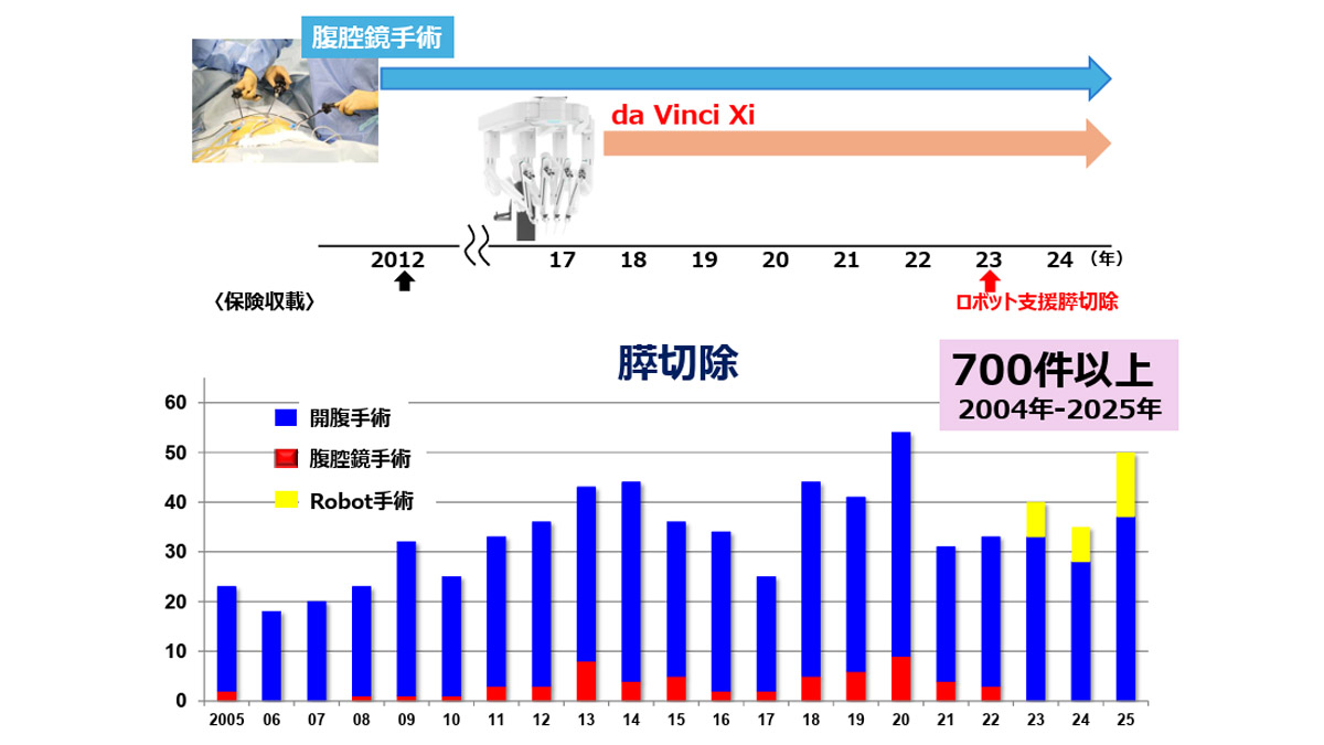 膵臓手術の進化 タイムラインと年別術式棒グラフ