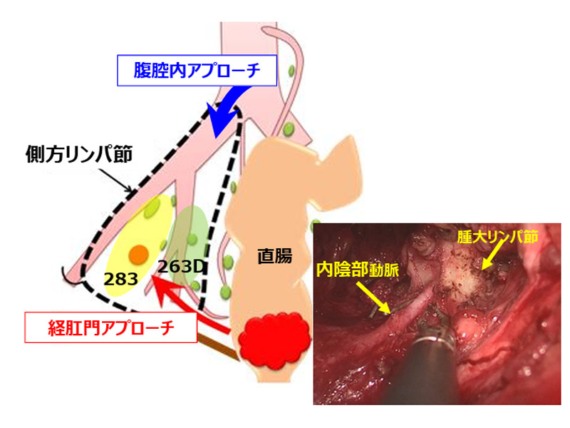 Hybrid側方リンパ節郭清