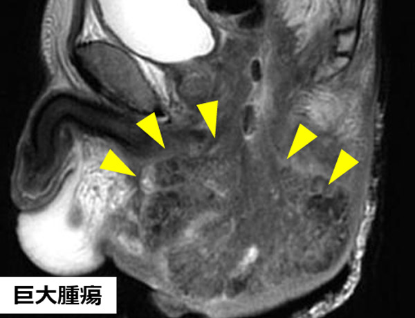 化学放射線療法前 MRI