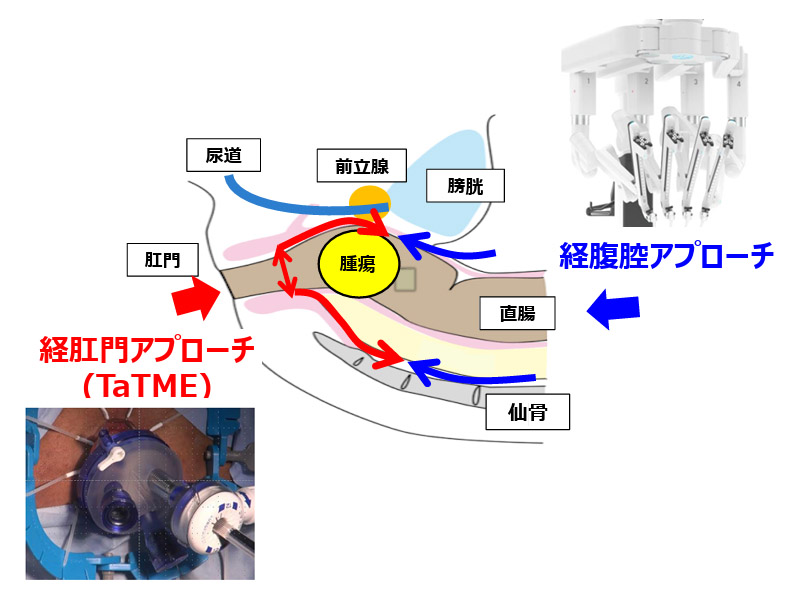 TaTME アプローチ解剖図