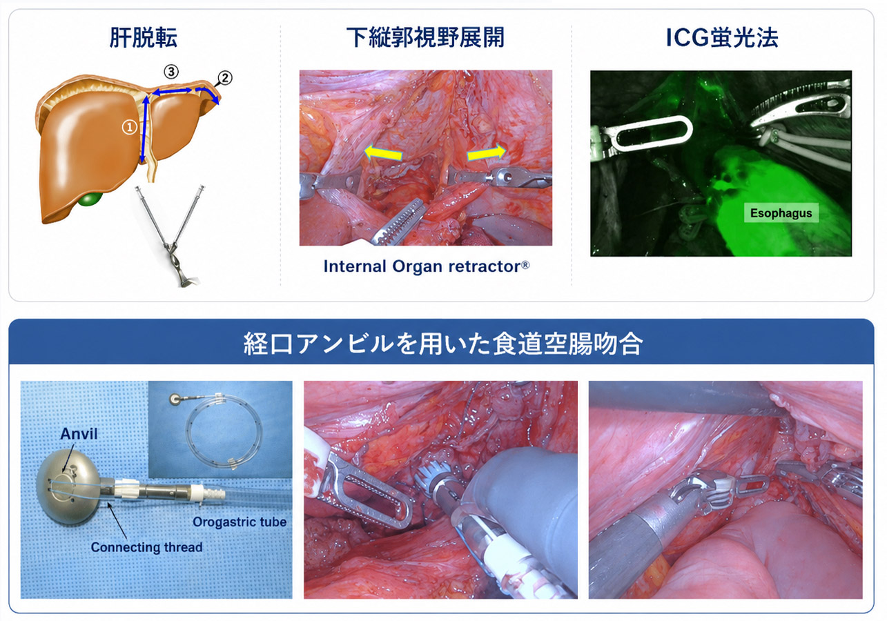 食道胃接合部癌 手術手技