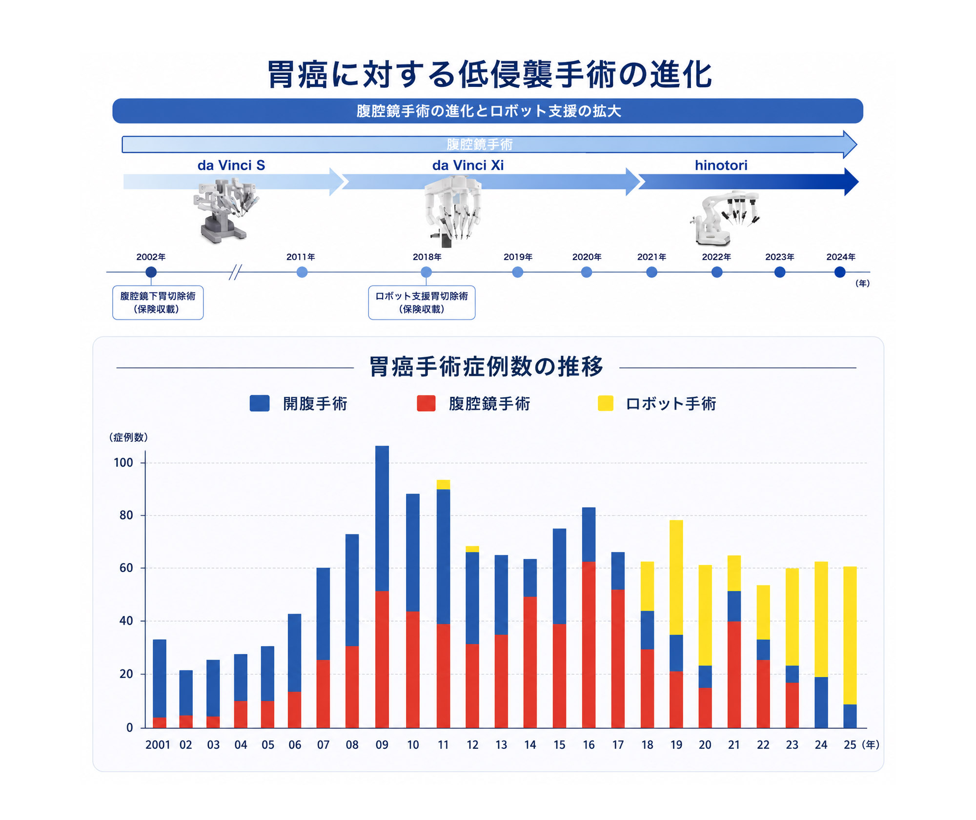 胃癌に対する低侵襲手術の進化