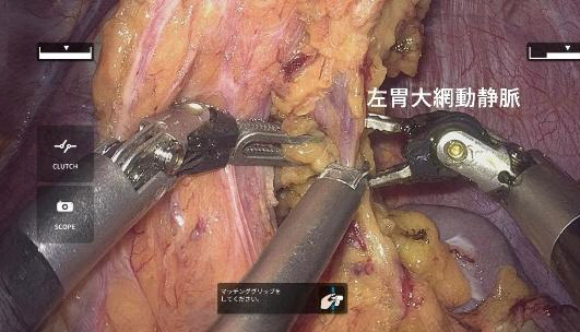 hinotori 手術 左胃大網動静脈