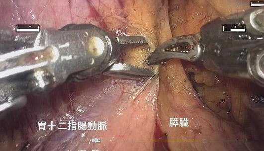 hinotori 手術 胃十二指腸動脈