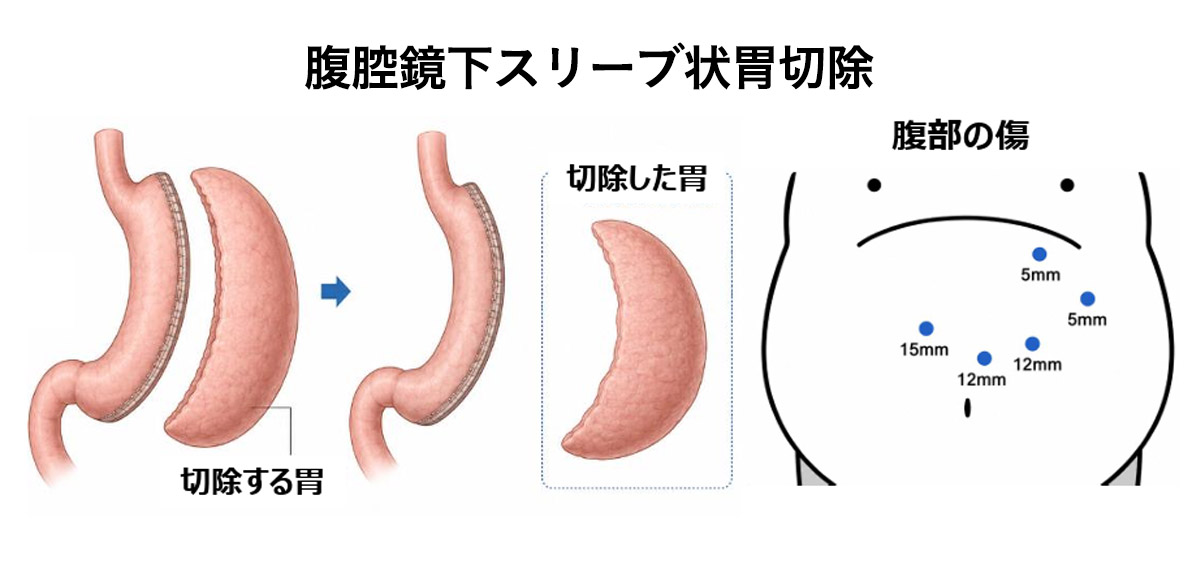 腹腔鏡下スリーブ状胃切除 イラスト